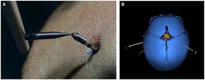 Frameless robot-assisted stereoelectroencephalography-guided radiofrequency: methodology, results, complications and stereotactic application accuracy in pediatric hypothalamic hamartomas